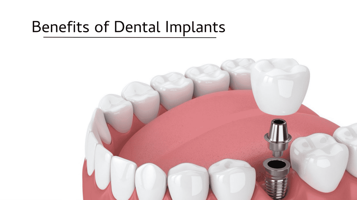 Benefits of Dental ImplantsWaterfall Magazine