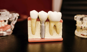 Everything You Need to Know About Dental Implants