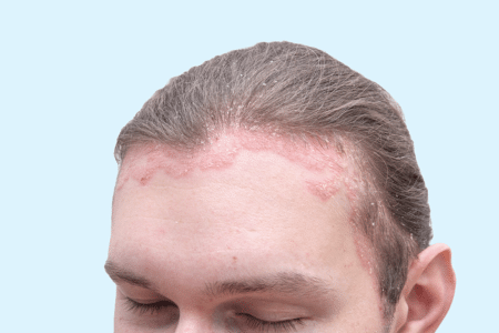 How to Treat Psoriasis on Skin Naturally?