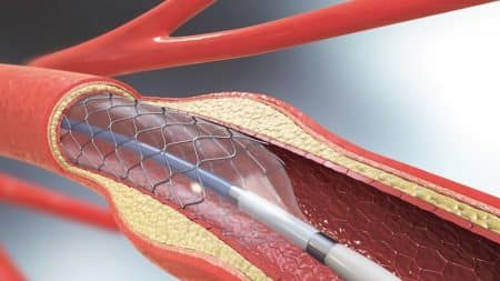 What are Stents Used in Angioplasty?